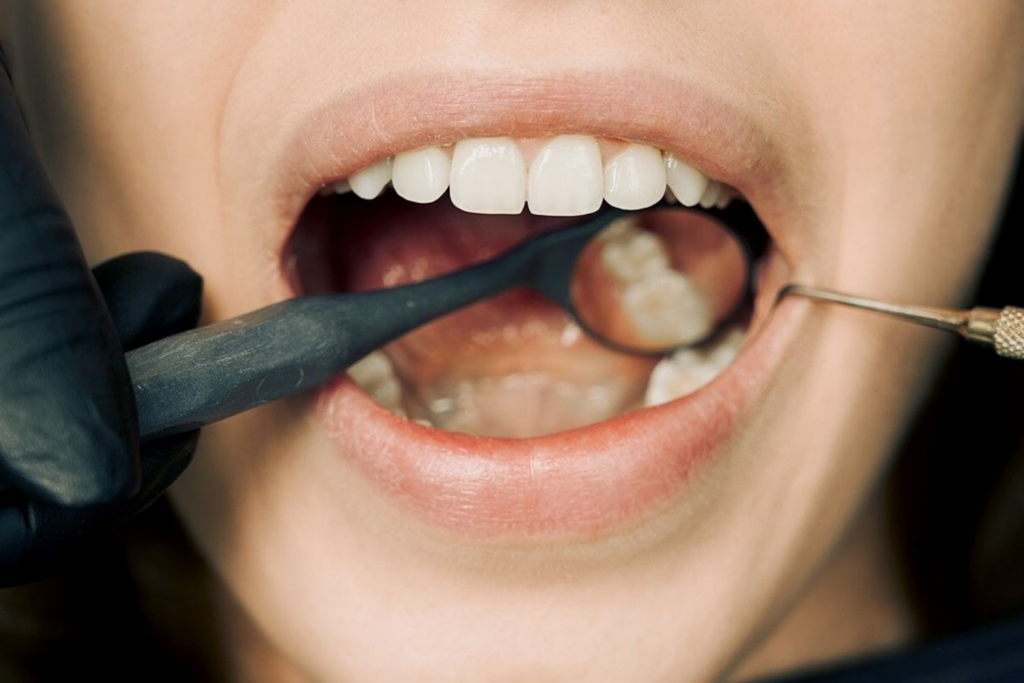Caries