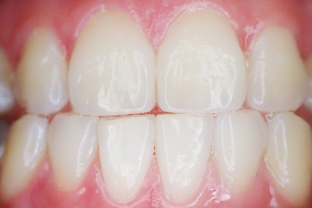 Dente