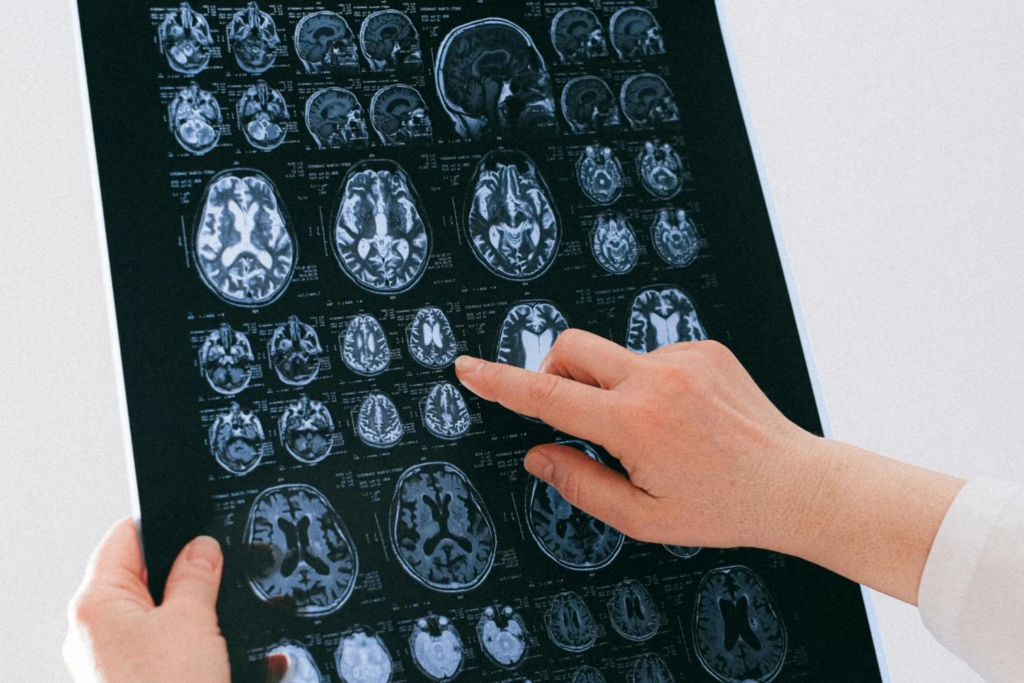 Nova Era Para O Parkinson