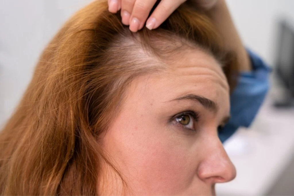 Perdendo Cabelo (2)