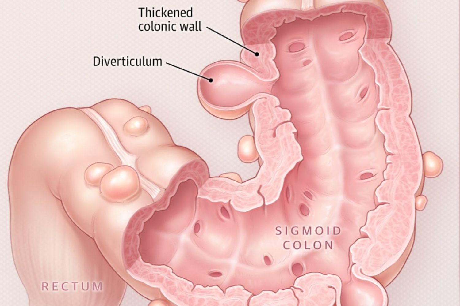 Diverticulite: o alerta no intestino que muita gente ignora
