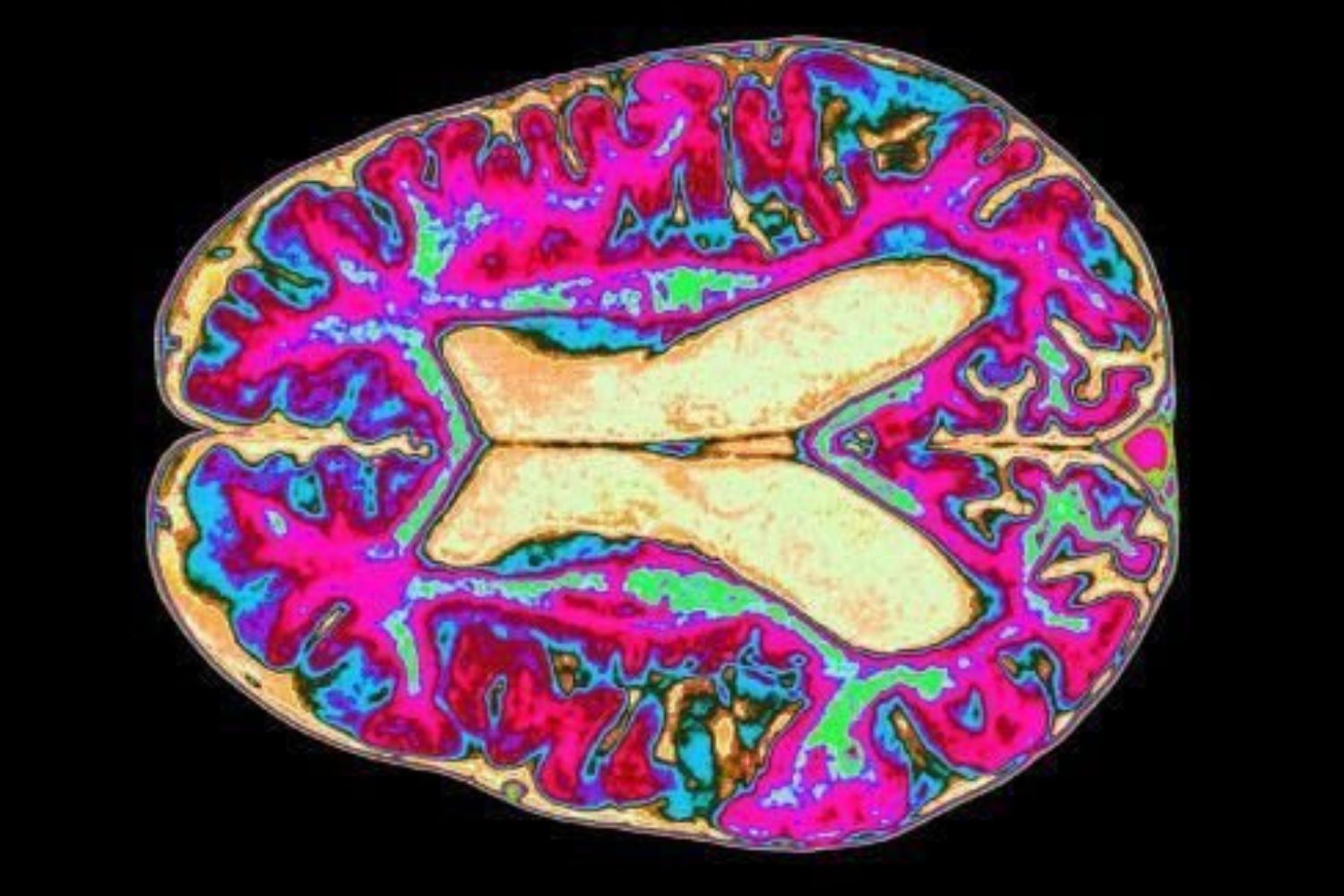 Ansiedade pode reduzir nutriente essencial no cérebro, aponta estudo