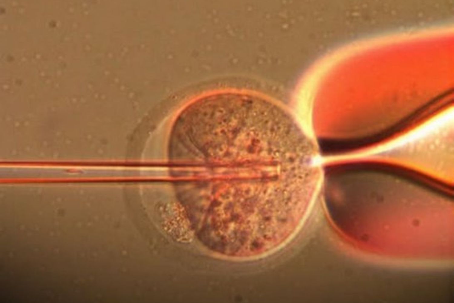 Cientistas conseguem apagar o cromossomo extra do síndrome de Down