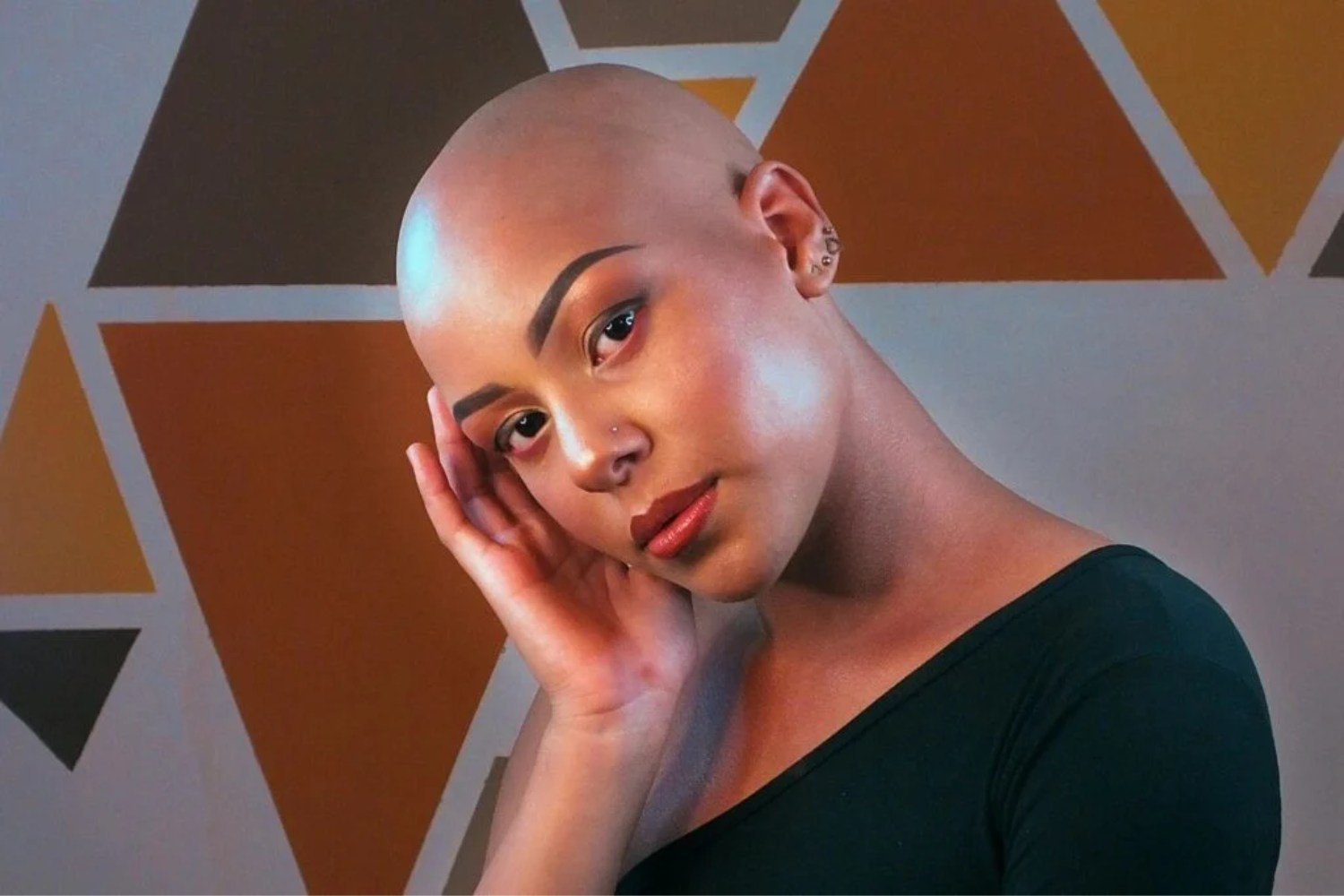 Alopecia Por Tração