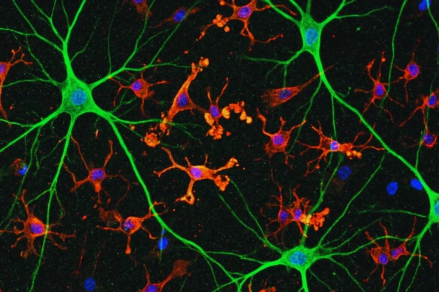 Alzheimer6