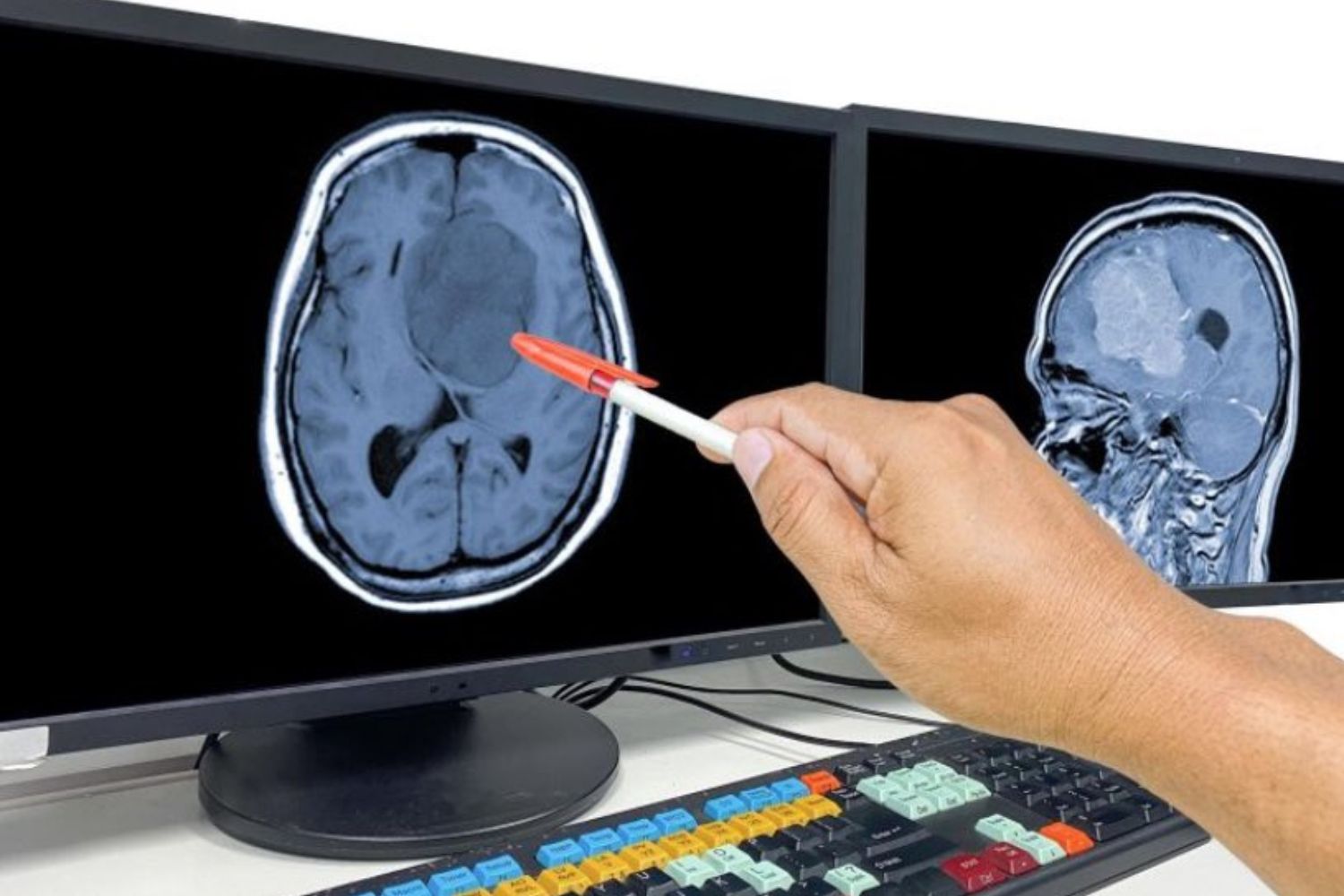 Um estudo recente revelou que um vírus modificado pode ativar o sistema imunológico contra um dos cânceres mais letais