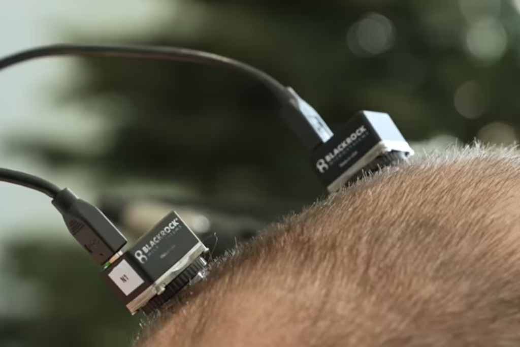 Um Implante Cerebral Devolveu A Voz A Um Homem Com Ela Ele Já Usou A Tecnologia Por Quase 4 Mil Horas E Diz Que Voltou A Fazer Parte Das Conversas