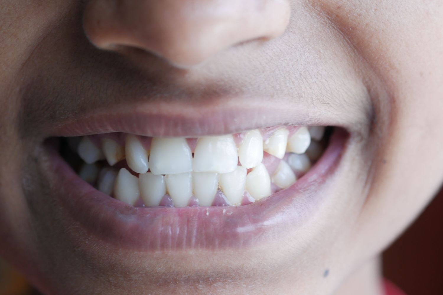 Adeus à sensibilidade? Novo gel consegue reconstruir parte do esmalte dos dentes em testes científicos