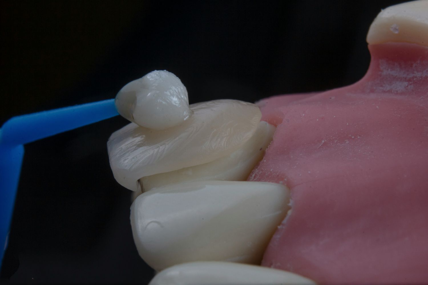 Adeus à sensibilidade? Novo gel consegue reconstruir parte do esmalte dos dentes em testes científicos