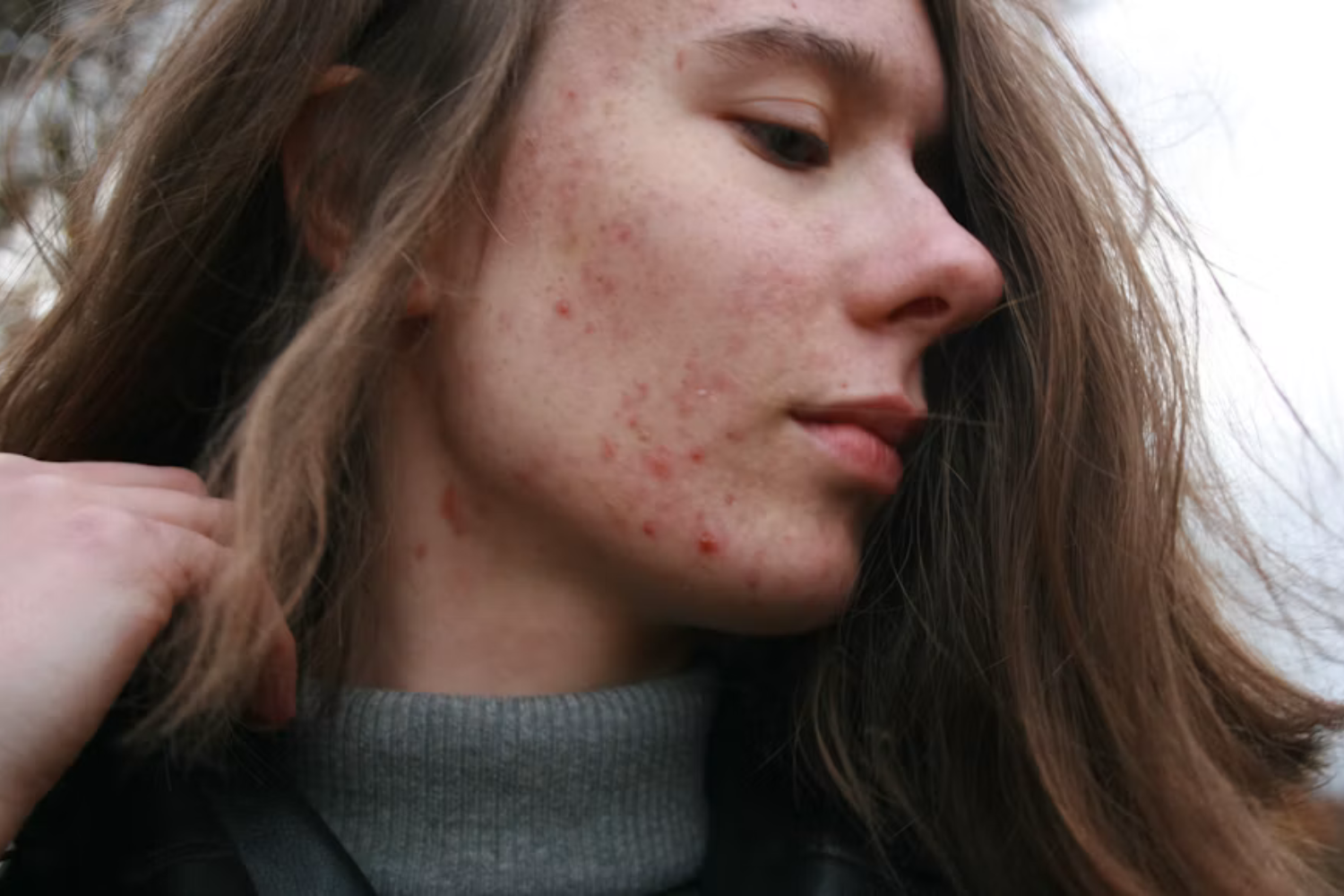 5 Conselhos De Dermatologistas Para Adolescentes Cuidarem Da Pele Sem Exagerar