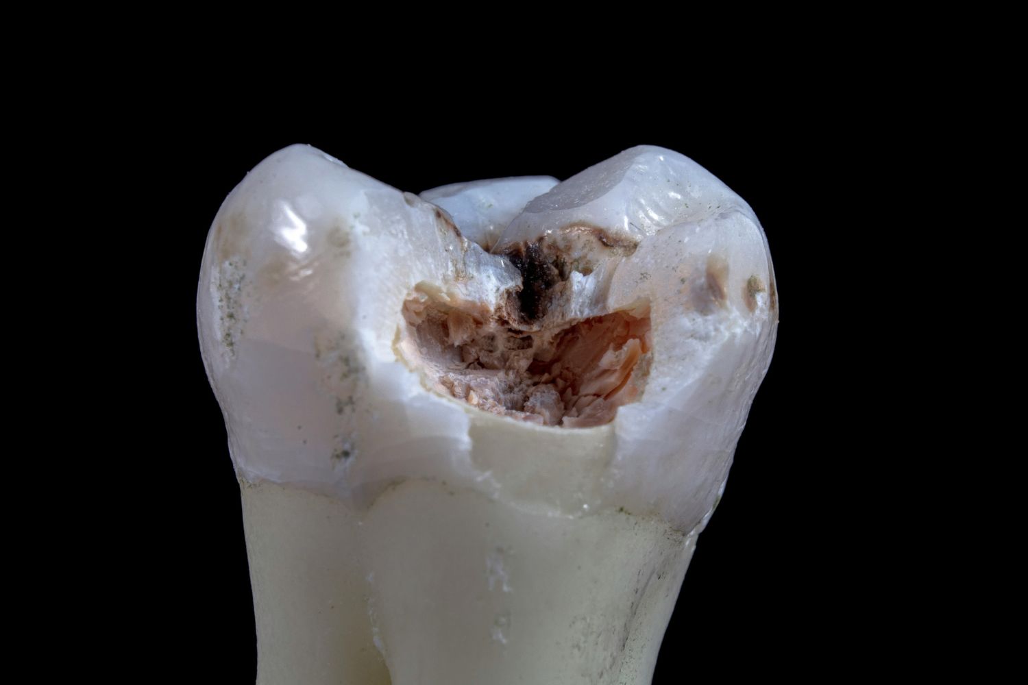 Uma estranha marca nos dentes revelou como humanos pré-históricos tentavam enfrentar a dor