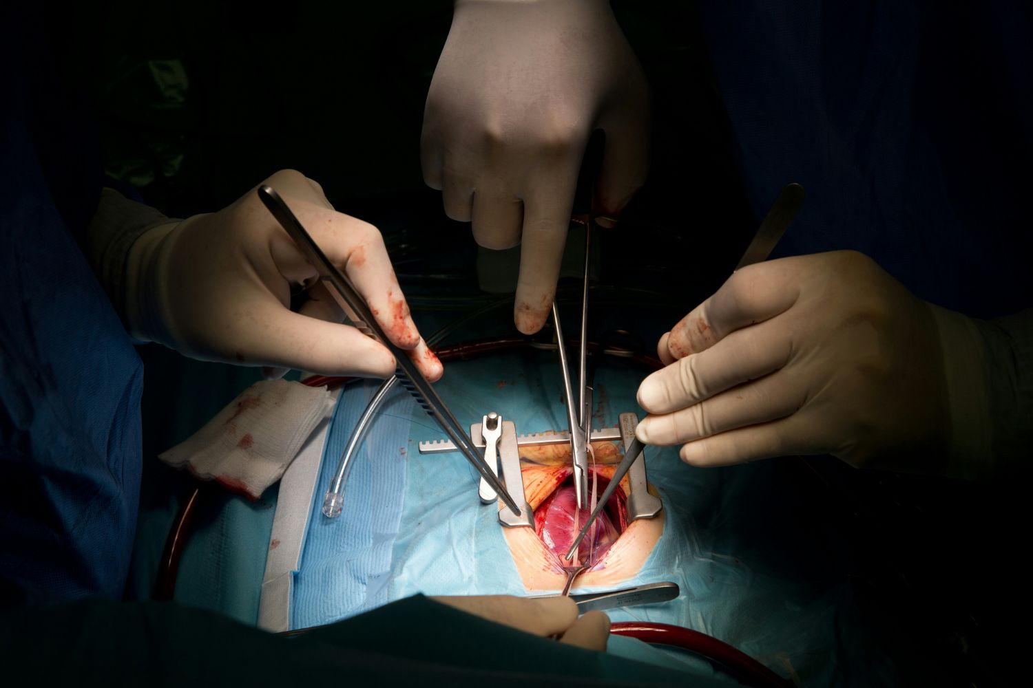 Um coração transplantado pode começar a “mudar de idade” dentro de outro corpo, revela estudo