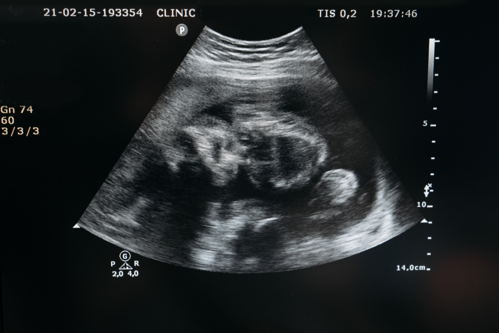 Cérebro Fetal