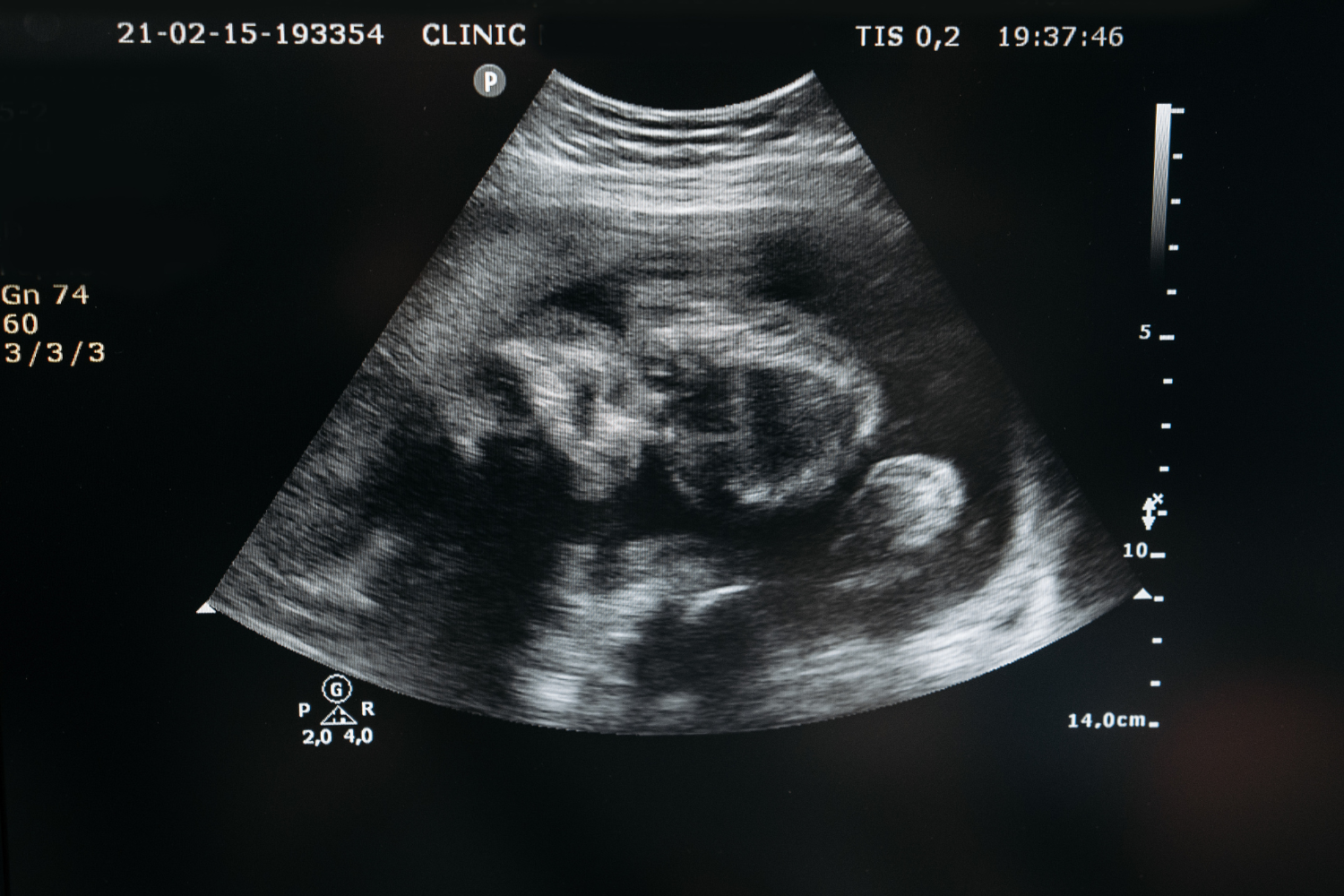 Cérebro Fetal