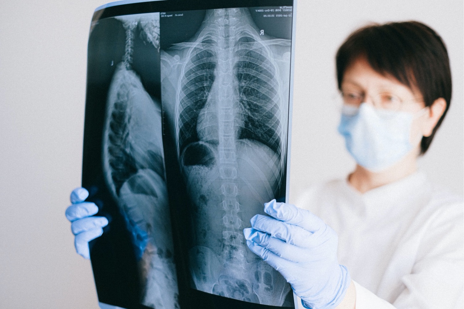 O que é o adenocarcinoma pulmonar e por que ele pode crescer sem apresentar sintomas