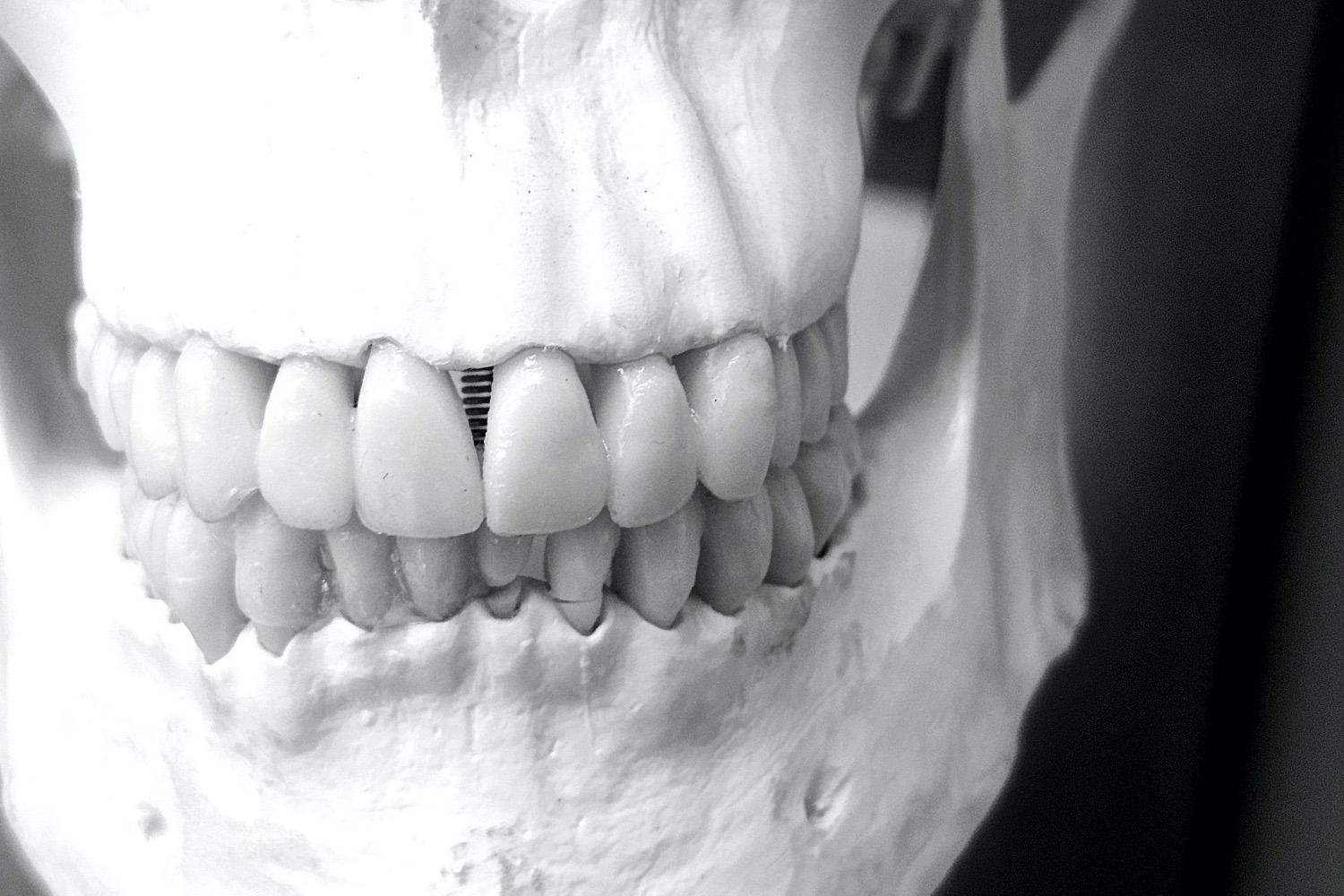 Bone smashing: a perigosa tendência do TikTok que promete definir o maxilar, mas pode deformar o rosto